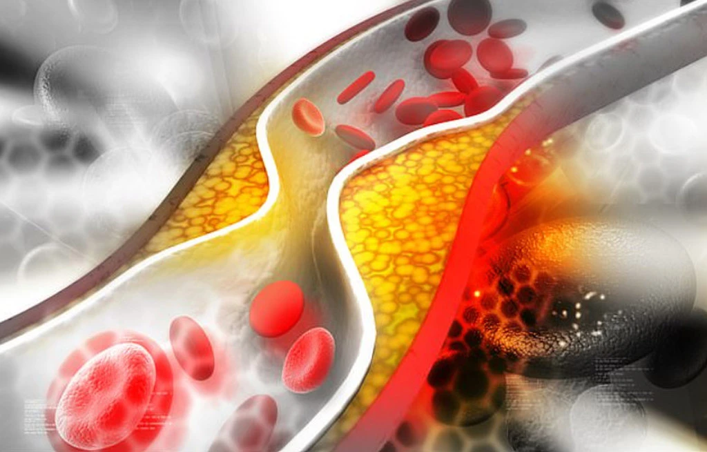 Liệu pháp tự nhiên giảm cholesterol tránh xơ gan, đột quỵ